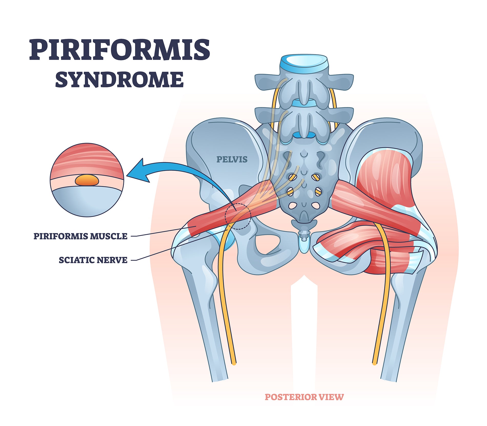 Piriformis syndrome, Causes, Symptoms & Treatment
