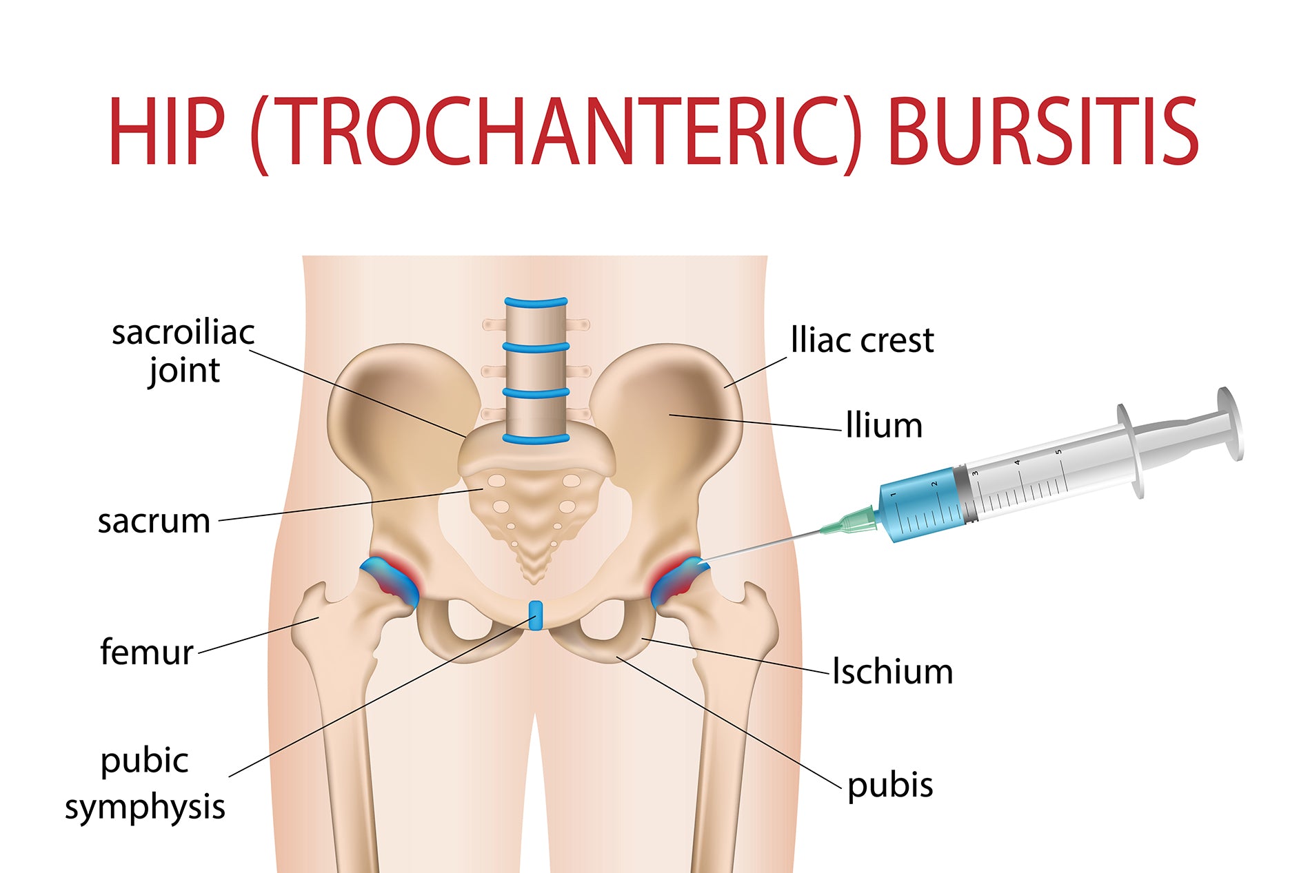Hip Bursitis - What You Need to Know