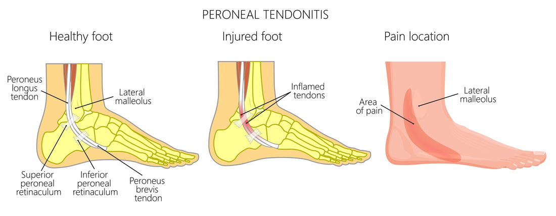 Peroneal Tendonitis & Tear Overview – Sacksy Thyme